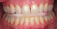 Vertical Dimension & Appliance Therapy