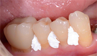 Tip & Trick: Blocking Out Negative Space in Polyvinyl Impression