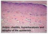 Solar cheilitis is most likely to appear in,