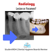 Q: The radiolucency in the image is: