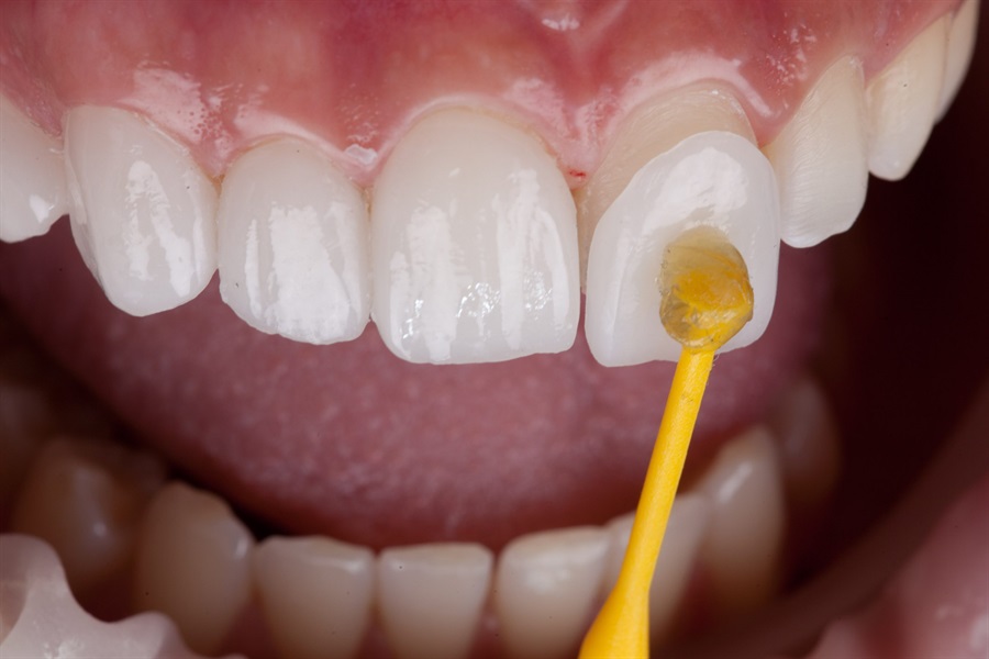 Give Your Teeth a Makeover with Veneers