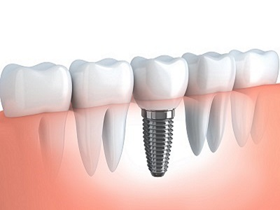 When To Save A Tooth? Part 1: Weighing the Pros and Cons