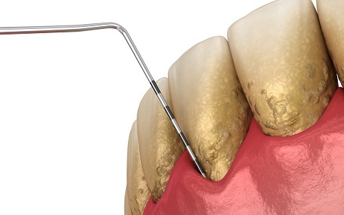 “Why Are My Gums Receding?”