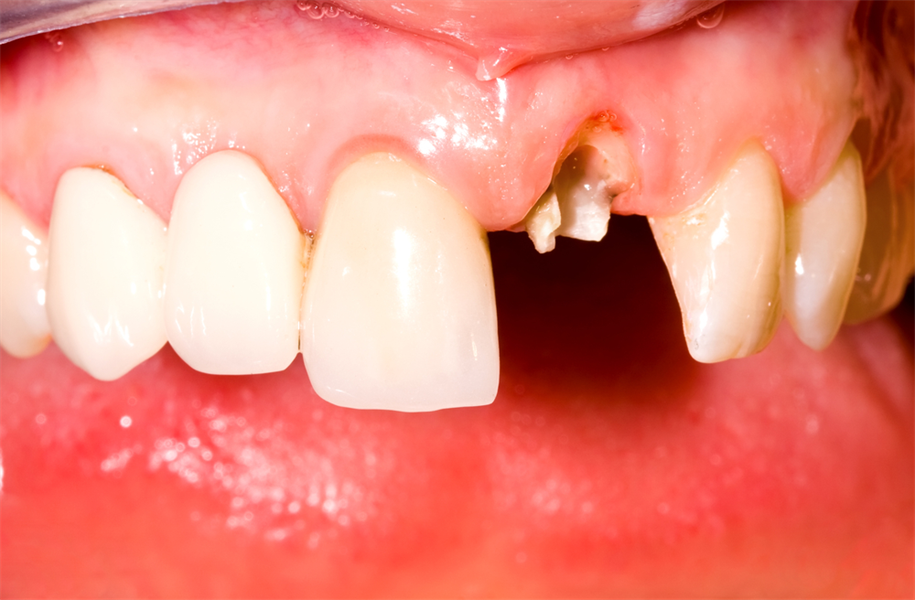 Aesthetic Crown Lengthening Part 2