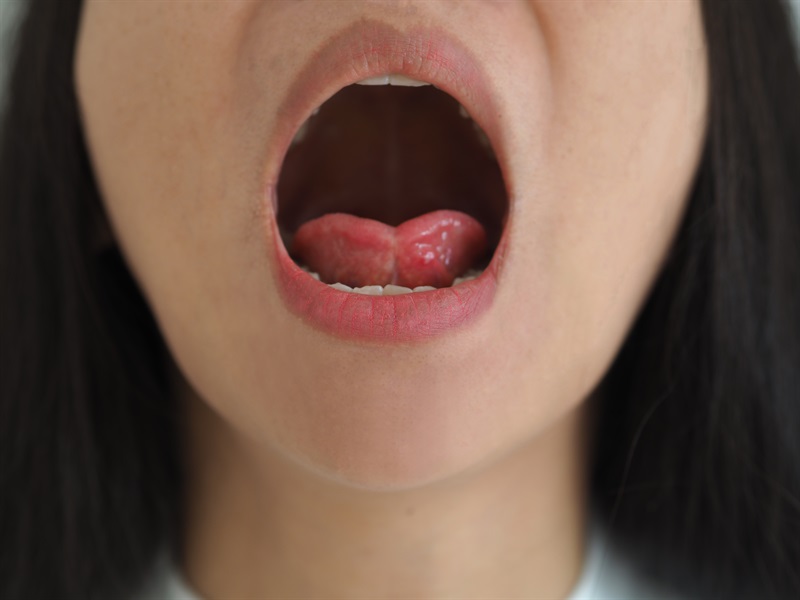 Mouth Breathing: A Modern Lifestyle Habit That Causes Gum Disease And Tooth Loss