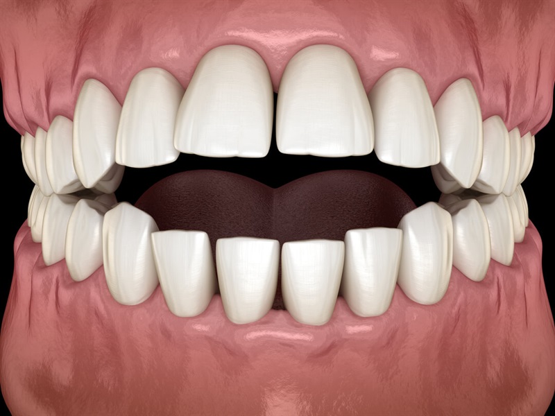 Is Invisalign effective in correcting an open bite?  