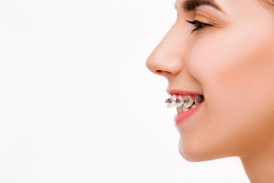 Overbite Correction With Braces