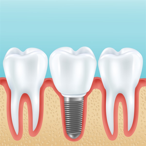Dental Implants Longevity: A Journey of Smile Restoration